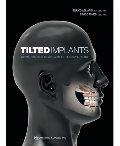Tilted Implants Implant-Prosthetic Rehabilitation of the Atrophic Patient